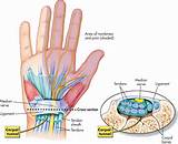Photos of Symptoms Of Carpal Tunnel