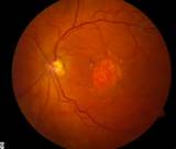 Eye Degeneration Symptoms Photos
