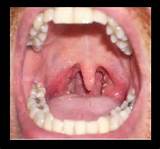 Throat Cancer Oral Photos