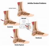 Injuries To Achilles Tendon Images