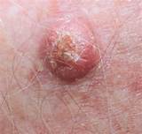 Images of Malignant Skin Tumor