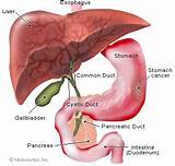 Types Stomach Cancer Images