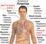 Anaemia Symptoms Images