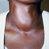 Images of Thyroid Risks And Symptoms Checklist
