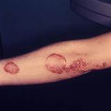 Images of Fish Oil Eczema