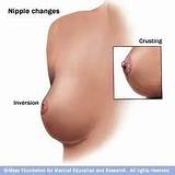 Breast Nipple Cancer Photos