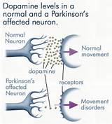 Symptoms Of Parkinson''s Disease Photos