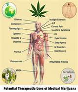 Conditions Treated By Medical Cannabis Images