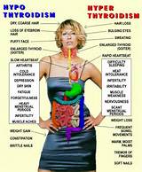 Goiter Hyperthyroidism Symptoms Images