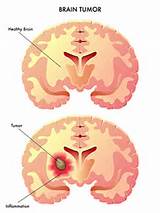 Brain Tumors By Age