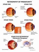 Retinopathy Of Prematurity Symptoms Pictures