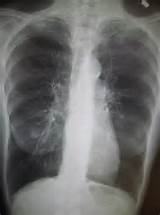 Chronic Obstructive Pulmonary Disease Also Known As Pictures