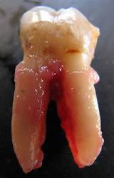 Symptoms Infection After Tooth Extraction Images