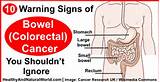 Pictures of Bowel Cancer Warning Signs