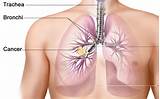 Adenocarcinoma Lung Cancer Pictures