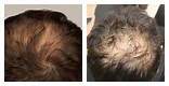 Hair Loss Crown of Head Men