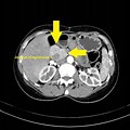Abdominal CT Scan Pancreatic Cancer