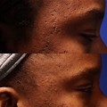 Acne Scars African American