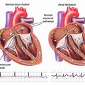 Alcohol Heart Arrhythmia