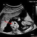 Anencephaly 8 Week Ultrasound