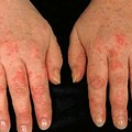Arthritis Skin Rash