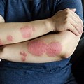 Autoimmune Disease Skin Rash