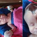 Babies Born with Anencephaly