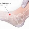 Bone Spur Ankle Pain