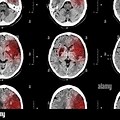CT Scan Brain Ischemic Stroke