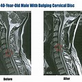 Cervical Spine Bulging Disc