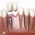 Dental Implant Cantilever Bridge