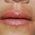 Eczema Rash around Mouth