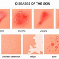 Examples of Common Skin Diseases