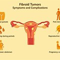 Fibroid Tumors On Ovaries