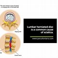 Herniated Disc Sciatic Nerve