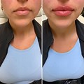 Lip Filler Immediately After