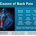 Lower Back Pain Symptom Chart