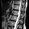 MRI Lumbar Spine without Contrast Anterior View