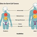 Malignant Germ Cell Tumor