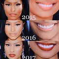 Nicki Minaj Teeth Before and After