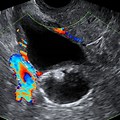 Ovarian Dermoid Transvaginal Ultrasound