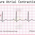 Pac Premature Atrial Contraction ECG