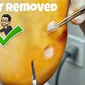 Plantar Wart Removal Surgery