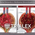 Post-Streptococcal Glomerulonephritis vs Normal Glumeruli