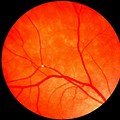 Retina Blood Clot