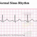 Sinus Rhythm ECG