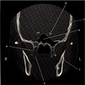 Sphenoid Fracture in Coronal CT Scan