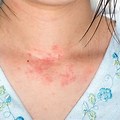 Symptoms of Allergic Reaction to Skin