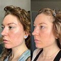 Tretinoin Before and After Acne Scars
