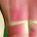 Uneven Skin Sun Burn